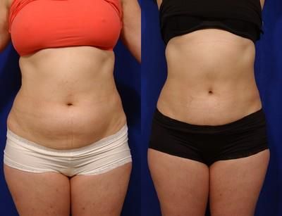 mesotherapy injections before and after stomach via telemedicine